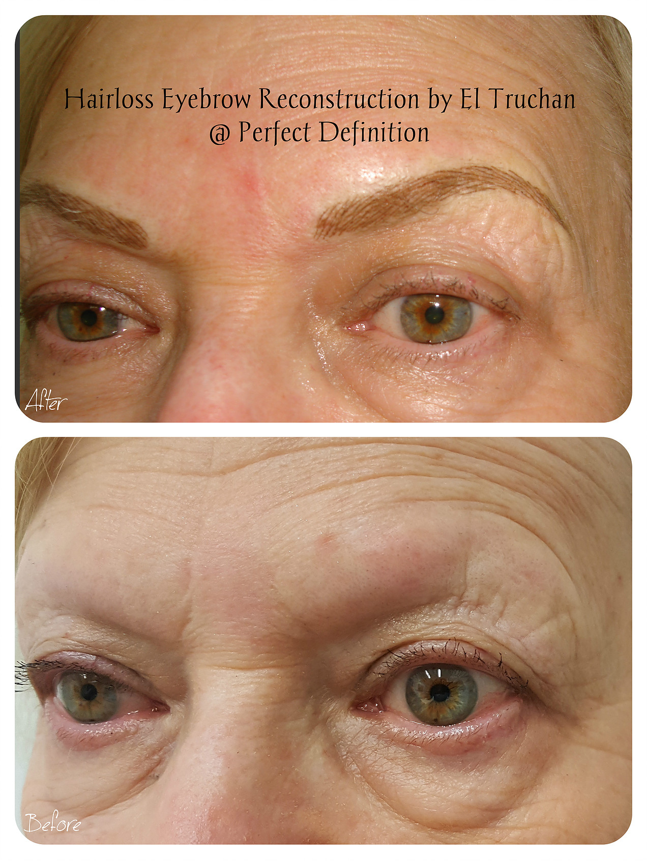 Hairloss Eyebrow Reconstruction by El Truchan C.P.C.P. Press Room